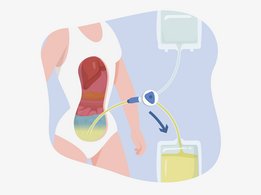 [Translate to Slovakia - Slovak:] Peritoneal dialysis